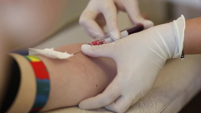 Blood donation concept. A donor gives blood. A close-up of a hand with a small blood bag attached during a blood donation. Donating blood for the military.