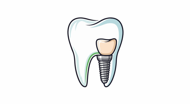 Stylized illustration of a tooth with a dental implant and crown