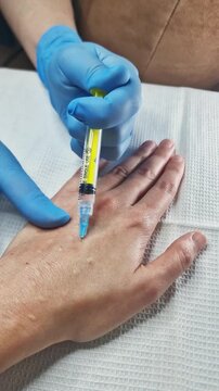 A series of shallow injections into the hand to distribute bio-revitalizing serum, creating small papules on the skin surface. Macro view in a clinic.