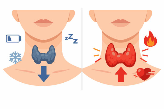 Medical Illustration Comparing Hypothyroidism and Hyperthyroidism Symptoms in the Human Thyroid Gland, Featuring Icons for Fatigue, Cold Sensitivity, Heat Intolerance, and Tachycardia in Flat Vector