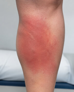 Cellulitis Red Inflamed Skin Infection on Lower Leg Close Up
