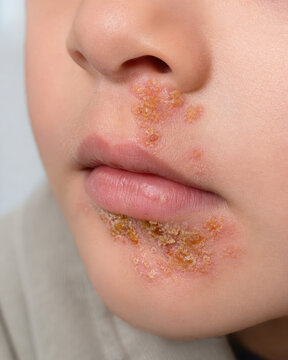 Impetigo with Honey Colored Crust on Child Face