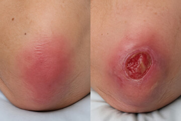 Fototapeta premium Pressure Ulcer Stages from Early Redness to Open Wound