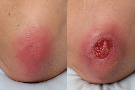 Pressure Ulcer Stages from Early Redness to Open Wound