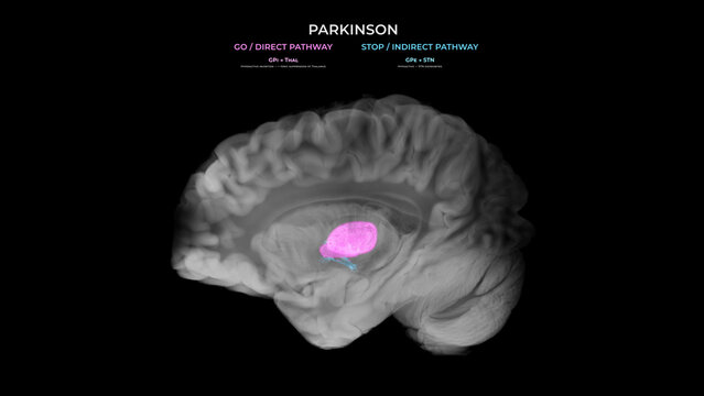 Parkinson Dopamine Loss Basal Ganglia Direct and Indirect Pathway Imbalance in Sagittal View
