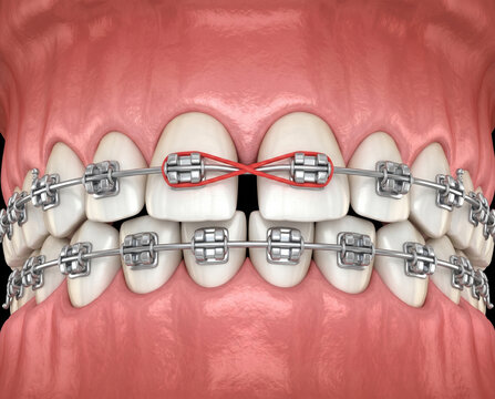 Ilustraci&oacute;n 3D de brackets dentales con el&aacute;sticos ortod&oacute;nticos