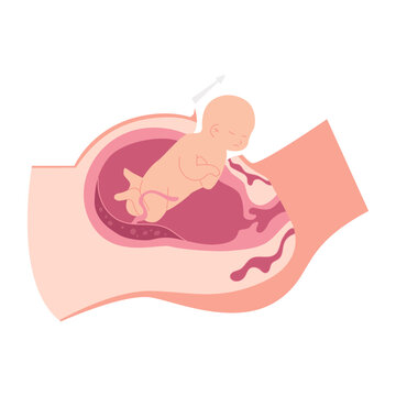 Caesarean Section Steps Medical Illustration