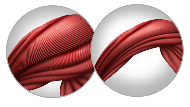 Muscle Atrophy as a decrease in size of muscles and reduced strength from disuse aging or illness as Cancer Cachexia with appetite reduction due to disease losing physical body mass and fat resulting 