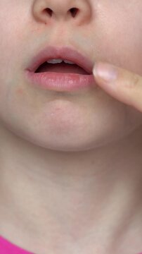 Mothers hand applies ointment to mouth of child with angular stomatitis. Girls face with perleche. Angulit. Vertical shot