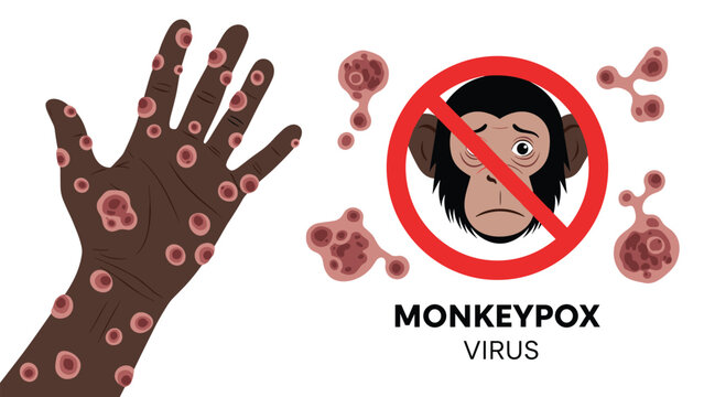 Medical illustration showing symptoms of monkeypox virus with infected hand lesions and monkey icon for awareness.