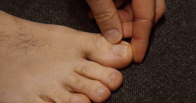 Close-up of a toe with an ingrown toenail being pressed, representing discomfort, foot care, and treatment.