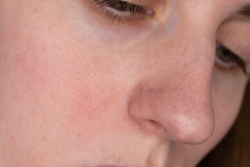Fototapeta premium Macro close-up of woman face showing redness and sensitive skin on nose. Dermatology, skincare problems and irritation concept, natural texture.