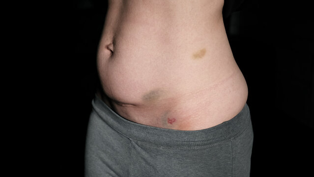 Fresh medical scars on female abdomen after laparoscopic surgery. Stretch marks on light caucasian skin after cesarean section on dark background. Body Lymphatic edema. Maternity concept. Front view.