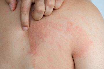 Fototapeta premium Close up of a man with a red skin rash and inflammation on his back. A person scratching an itchy allergic reaction, eczema, or dermatitis on the body. Concept of healthcare and dermatology, urticaria