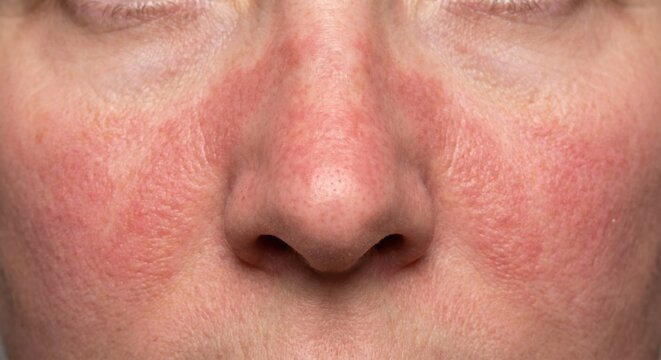 Rosacea skin condition with butterfly rash on face