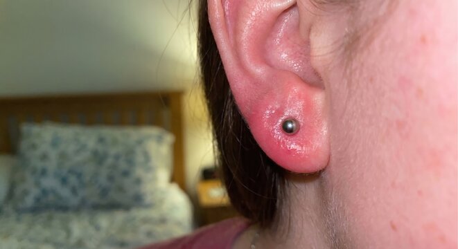 Inflamed earlobe with silver stud piercing