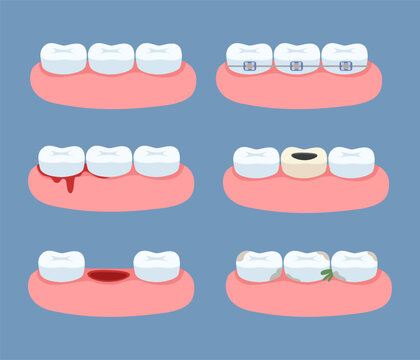 Set of icons illustrating dental problems, braces, gum bleeding, oral hygiene, tooth decay, tooth extraction, and whitening. Concept of dental care