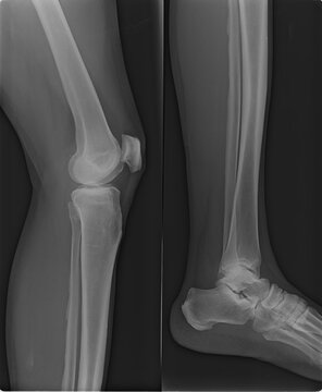 Radiographic imaging of the lower leg including the patella, tibia, and tarsal bones for orthopedic diagnostic analysis.