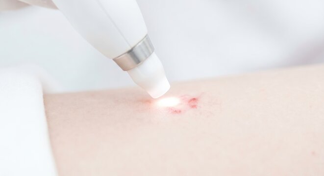 Cosmetic laser treatment of vascular skin lesion
