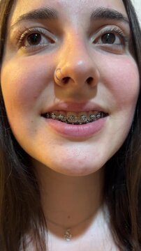 Detalle del rostro de una chica con brackets sonriendo