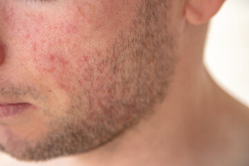 Fototapeta premium Facial skin redness and irritation on a young man’s cheek, suggesting inflammation or dermatitis in a close-up dermatology concept.