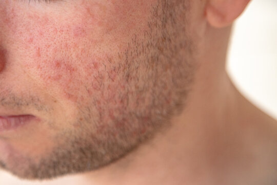 Facial skin redness and irritation on a young man&rsquo;s cheek, suggesting inflammation or dermatitis in a close-up dermatology concept.