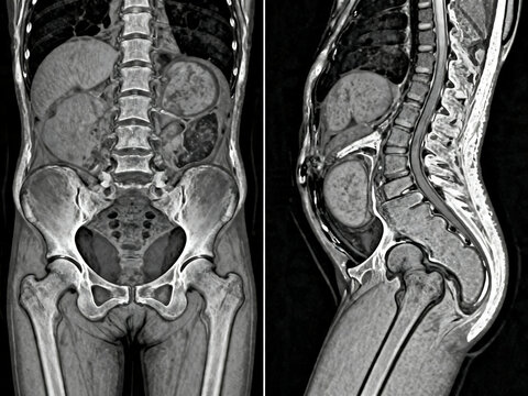 Medical MRI scan of human spine and pelvis, coronal and sagittal views of lumbar vertebrae, diagnostic radiology imaging for spinal health isolated on White Background