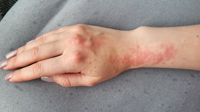 Macro shot of skin texture with small sun allergy papules