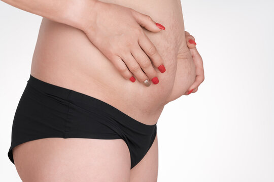 Closeup of woman's midsection with stretch marks and excess skin after pregnancy or weight loss. Body positivity concept on white background. Red nails. Studio shot with copy space