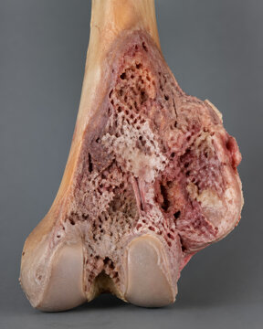 Osteosarcoma of the Distal Femur Pathology Cutaway