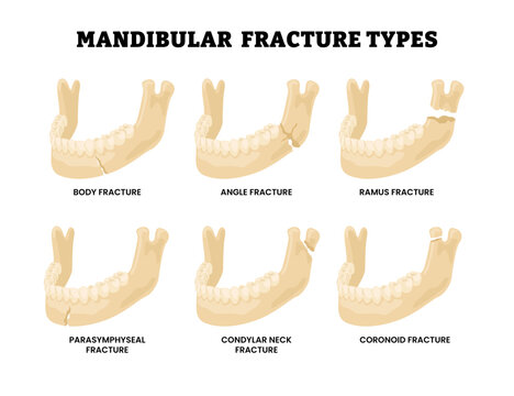 Different types of mandibular fracture types. Labeled body angle ramus parasymphyseal condylar neck and coronoid fracture diagram hand drawn schematic. Medical science illustration poster.