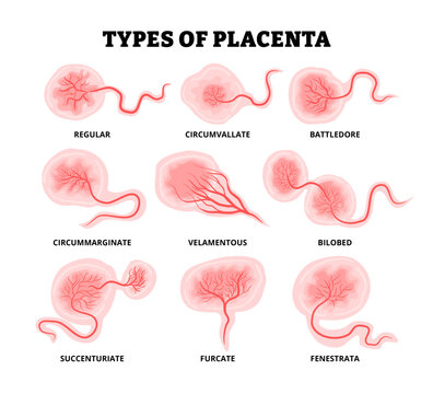 Different types of placenta variations types. Labeled reguler, circumvallate battledore circummarginate velamentous bilobed succenturiate furcate fenestrata.  Flat vector medical illustration.