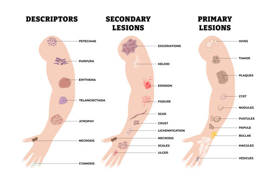 Different types of skin disease types. Labeled descriptors and lesions. Skin assessment poster diagram illustration with hives, tumor, plaques, cyst, nodules, pustules, papule, bullae, macules, etc.