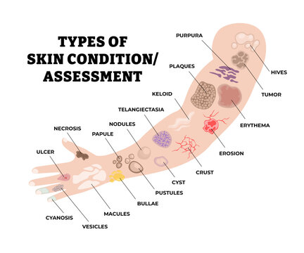 Different types of skin disease types. Labeled descriptors and lesions. Skin assessment poster diagram illustration with hives, tumor, plaques, cyst, nodules, pustules, papule, bullae, macules, etc.