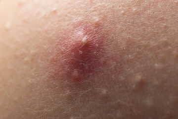 Fototapeta premium Acne skin pimple. Skin problem with pimple bumps. Irritated pimple texture. Close up pimple issue.