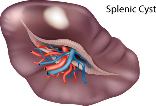 Splenic Cyst Medical Illustration Human Spleen Anatomy Cross Section Vascular Structure. Splenic Cyst Pathology Diagram 