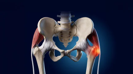 Trochanteric Bursitis. Inflamed Hip Bursa Anatomy Diagram with Iliotibial Band and Femur. Labeled © Axel Kock