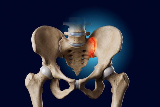 Sacroiliac Joint Pain Illustration Showing Lower Back and Pelvic Discomfort