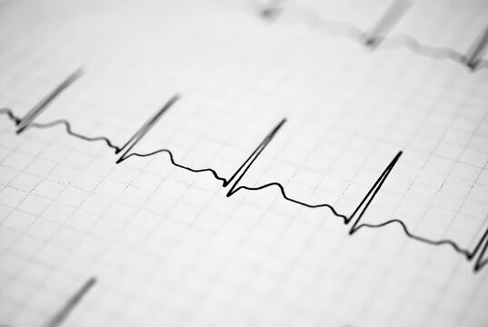 A heart rate monitor displaying an electrocardiogram (ECG) reading. It indicates a patient&rsquo;s cardiac activity in a medical setting.