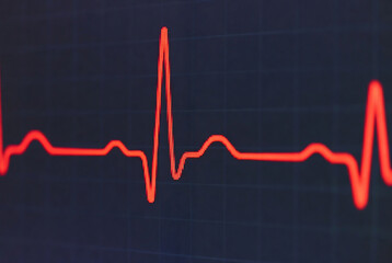 Fototapeta premium Electrocardiogram (ECG) reading indicating an irregular heartbeat. Medical monitoring station.