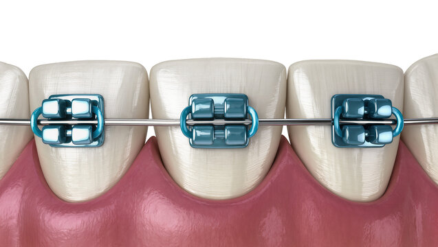 Blue Ceramic Braces Attached to White Teeth Dental Alignment