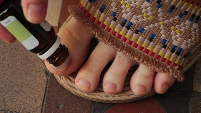 Close-up of antifungal drops being applied to a big toe. Concept of foot care, treatment, and hygiene. High quality 4k footage