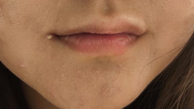 A pimple on the chin near the corner of the lips on the face of a teenage girl. Genuine women's leather.