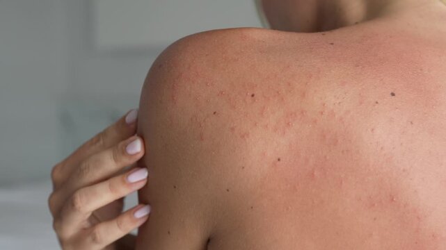 Extreme close up of female shoulder and back skin with small pimples and redness. Body acne and irritation caused by sun exposure or hormonal imbalance. Sensitive skin concept