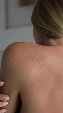 Young woman showing shoulder and upper back with small pimples and skin irritation. Close up of body acne caused by sun exposure or hormonal imbalance. Sensitive skin concept