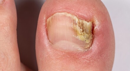 Naklejka premium Macro of ingrown toenail with fungal infection and inflammation