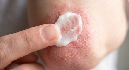 Fototapeta premium Applying medical cream to psoriasis skin on elbow