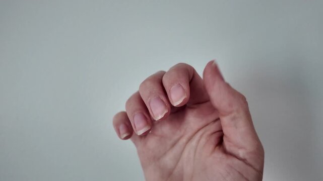 Close-up of damaged and broken fingernails on human hands. Unhealthy brittle nails with visible imperfections. Beauty, healthcare, manicure problem, and nail care concept