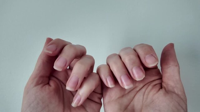 Close-up of damaged and broken fingernails on human hands. Unhealthy brittle nails with visible imperfections. Beauty, healthcare, manicure problem, and nail care concept