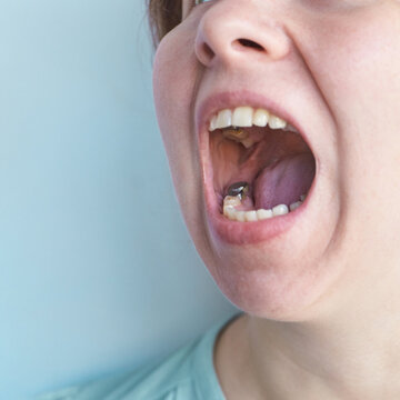Close up of open mouth showing dental filling inside molar tooth oral health problem and dentistry treatment concept isolated on light background